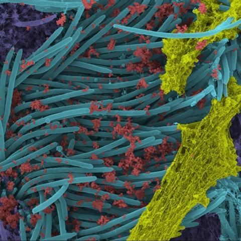 Coloured scanning electron microscope image of SARS-CoV-2 infected human bronchial epithelial cells